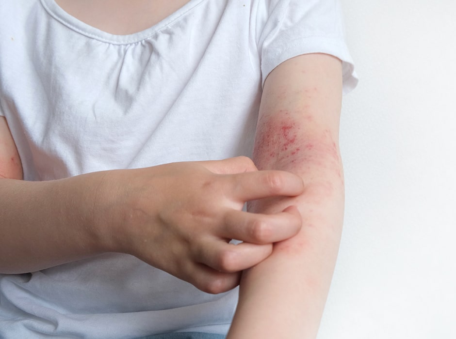 The Leading Eczema Clinic in London