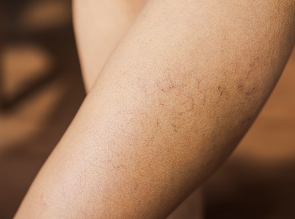 Thread Vein Removal Treatment in London
