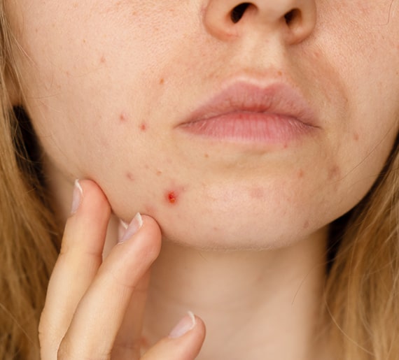 Comedonal (whiteheads and blackheads) acne