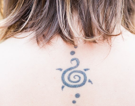Laser Tattoo Removal in London